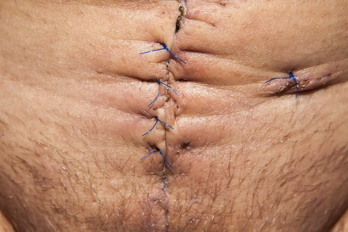 Cicatrice chirurgicală cusută pe abdomen, văzută din aproape, la câteva zile după operație